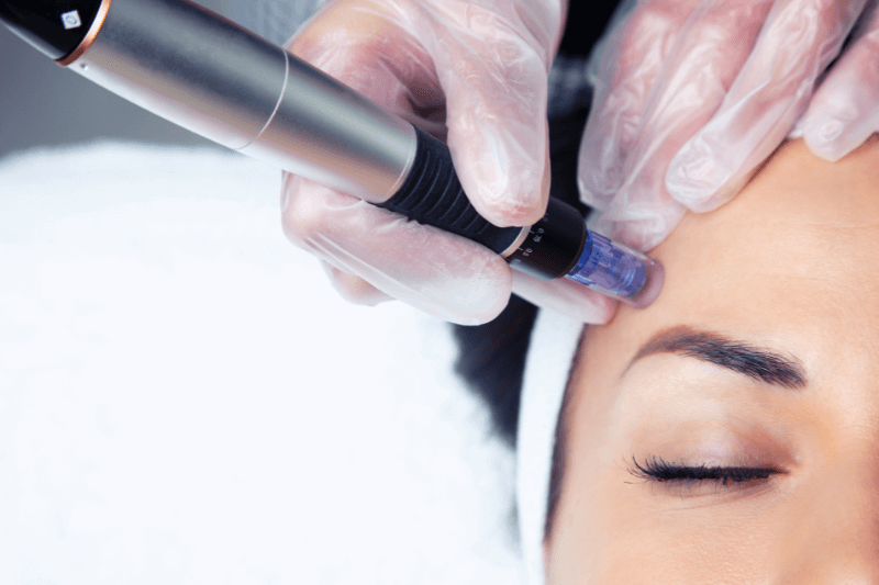 Microneedling Treatments